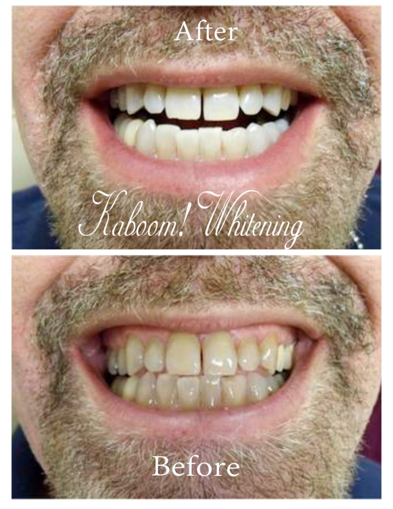 Smile Gallery Kaboom! Teeth Whitening